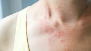 Mengatasi Dermatitis Atopik: Tips dan Solusi untuk Kulit yang Sehat