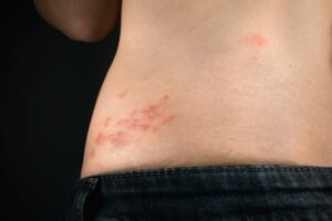 Mengatasi Herpes Zoster