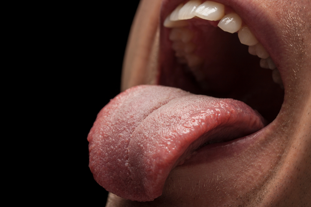 Glossitis