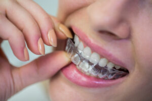 Aligner